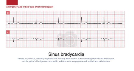 Sinus-Herzfrequenz weniger als 60 Schläge pro Minute bei Erwachsenen wird als Sinus-Bradykardie bezeichnet. Eine Sinus-Herzfrequenz von 40 bis 50 Schlägen pro Minute ist eine moderate Sinus-Bradykardie, und die Patienten können Symptome wie Herzklopfen und Schwindel haben..