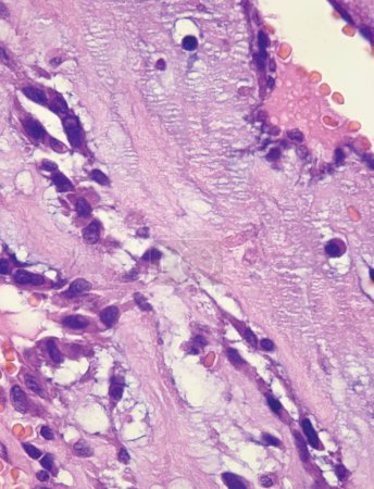 Esta foto muestra la matriz mucinosa rosa y la disposición lineal de las células tumorales mucinosas en el mixoma auricular..