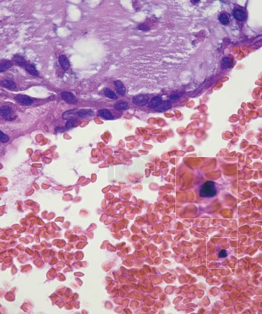 Los cuerpos de Gandy-Gamna son cambios patológicos que involucran hemosiderosina y depósitos de sal cálcica producidos por la descomposición de glóbulos rojos y la encapsulación de tejido fibroso..