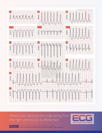 Ventricular tachycardia originating from the right ventricular outflow tract can be sustained or short-burst, and is a benign idiopathic ventricular tachycardia.