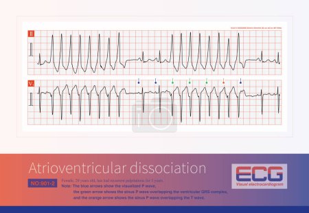 The presence of atrioventricular dissociation in wide-complex tachycardia is highly suggestive of ventricular tachycardia.