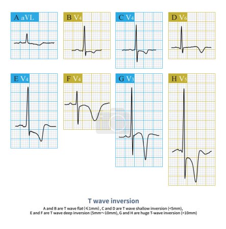 Téléchargez les photos : L'inversion d'onde T est un phénomène ECG commun, qui peut être un phénomène ECG normal et est plus fréquent dans les maladies cardiaques structurelles.. - en image libre de droit