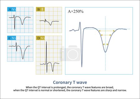Las ondas T normales son asimétricas. Las ondas T coronarias no son absolutamente simétricas, pero aumentan en simetría. Desde la parte inferior de la onda T hasta la parte inferior, la asimetría aumenta gradualmente.
