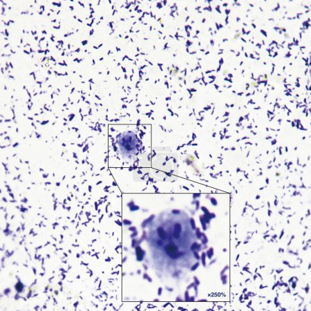 Giardia is a parasitic disease caused by Giardia duodenalis. Patients have diarrhea, abdominal pain and weight loss.Magnify 400x.