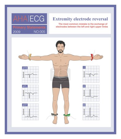 Photo for When the limb leads are reversed, it is common for the left upper limb and the right upper limb to be reversed, affecting the ECG pattern of the limb leads. - Royalty Free Image