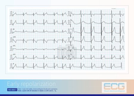 Photo for Early repolarization is a common benign ECG change that manifests as J-point ECG with or without ST-segment elevation. - Royalty Free Image