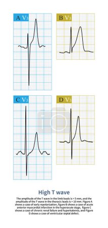 Photo for When the amplitude of the T wave exceeds 5 mm in the limb leads and 10 mm in the thoracic leads, it is called high T wave.High T waves can be seen in physiological and pathological conditions. - Royalty Free Image