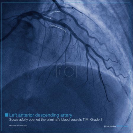 A 65-year-old man was admitted to the hospital with chest pain for 2 hours. Coronary angiography showed proximal-mid occlusion of the LAD, which was successfully opened and a stent was placed.