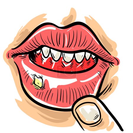 Illustration for Aphthous ulcers on mouth close up,, vector illustration cartoon flat design clip art - Royalty Free Image