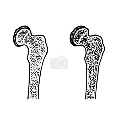 Téléchargez les illustrations : Os de la hanche sain et avec ostéoporose Illustration vectorielle - en licence libre de droit