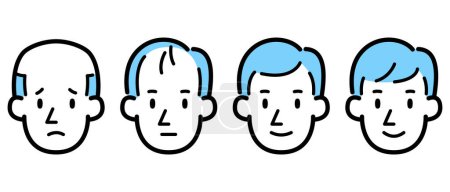 Ilustración de Conjunto de ilustración vectorial de adelgazamiento del cabello de los hombres - Imagen libre de derechos