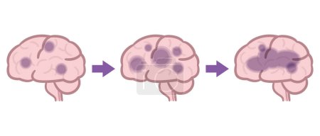 Téléchargez les photos : Illustration vectorielle de la maladie d'Alzheimer. cerveau - en image libre de droit