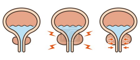 Illustration for Vector illustration of normal prostate and prostatic hypertrophy - Royalty Free Image