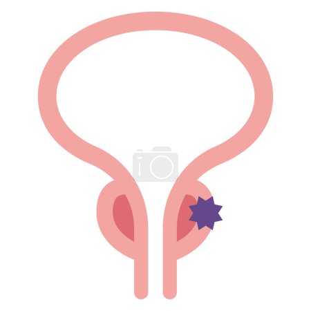 Ilustración de Ilustración vectorial del cáncer de próstata - Imagen libre de derechos