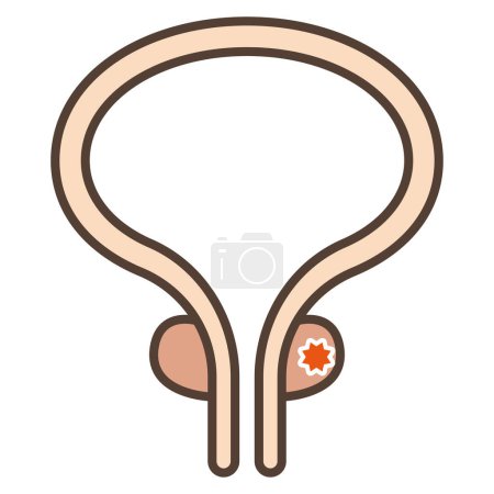 Ilustración de Ilustración vectorial del cáncer de próstata - Imagen libre de derechos