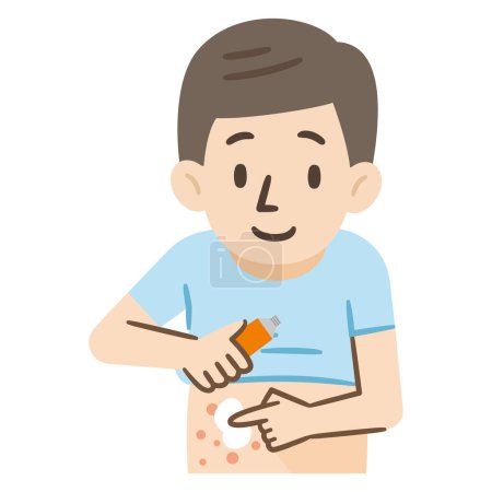 Ilustración de Ilustración vectorial de un hombre que trata el eczema con ungüento. - Imagen libre de derechos