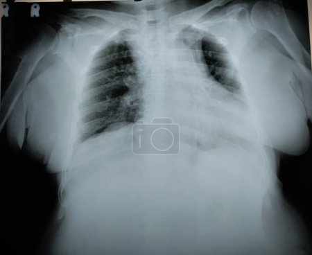 Photo for Chest X Ray of old women with cardiomegaly - Royalty Free Image