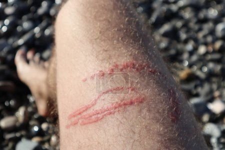 Téléchargez les photos : Une piqûre de méduses brûle la jambe d'un homme - en image libre de droit