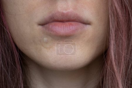 Photo for Round clear patch of acne on womens skin on the chin in close-up. - Royalty Free Image