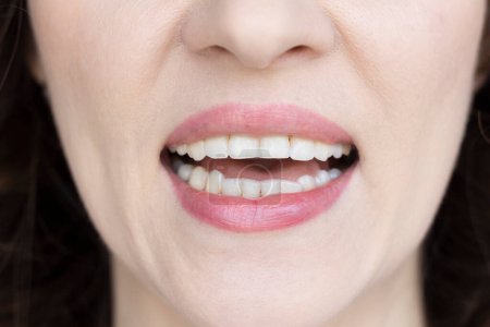 Téléchargez les photos : Femme montre ses dents cassées. Bruxisme, stress, malocclusion - en image libre de droit