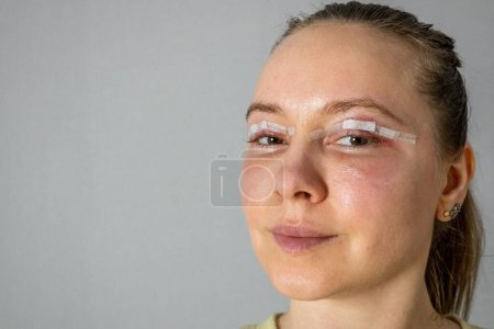 Photo for Woman face after plastic surgery, blepharoplasty operation, swelling eye bags, incisions with removable stitches, swollen skin and bruised eyelids. Cosmetic surgery to remove excess skin or fat - Royalty Free Image