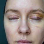 woman face recovery after plastic surgery, blepharoplasty operation, visible eyes wound cuts, swelling eye bags, swollen skin sutures and bruised eyelids. Cosmetic surgery to remove excess skin fat 