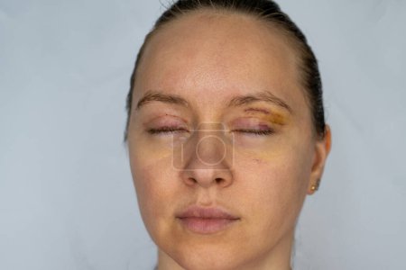 woman face recovery after plastic surgery, blepharoplasty operation, visible eyes wound cuts, swelling eye bags, swollen skin sutures and bruised eyelids. Cosmetic surgery to remove excess skin fat 