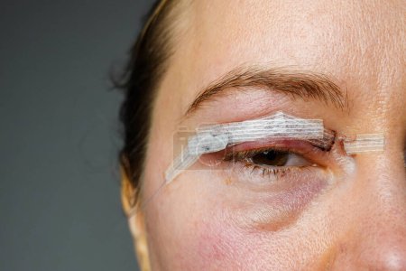 Photo for Close up woman eyes after plastic surgery, yellow red skin blood bruising, blepharoplasty operation, swollen bruised eyelids, incisions stitches sutures covered with medical tape, wound closure strips - Royalty Free Image