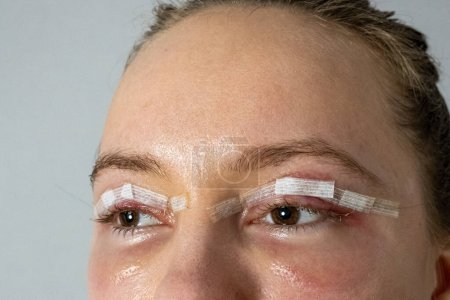 Photo for Close up woman eyes after plastic surgery, yellow red skin blood bruising, blepharoplasty operation, swollen bruised eyelids, incisions stitches sutures covered with medical tape, wound closure strips - Royalty Free Image
