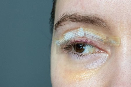 Photo for Close up woman eyes after plastic surgery, yellow red skin bruising, blepharoplasty operation, swollen bruised eyelids, incisions stitches covered with medical tape, wound closure strips - Royalty Free Image
