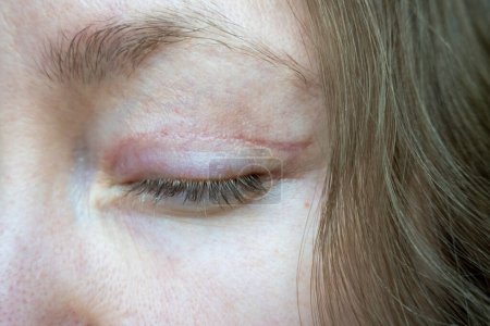 cara de mujer después de la cirugía plástica en los ojos, blefaroplastia operación, incisiones puntadas, cicatrización después de la operación, cicatriz de corte quirúrgico en el párpado, cicatrización de la piel herida