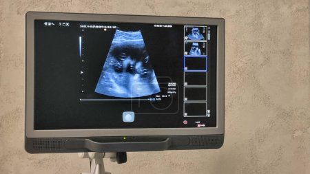 moniteur d'échographie avec des images de foetus, équipement d'échographie avec des photos de bébé, examen médical du corps de la patiente enceinte