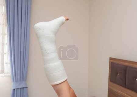 Téléchargez les photos : Une jambe cassée cheville et pied attelle bandage sur elle - en image libre de droit