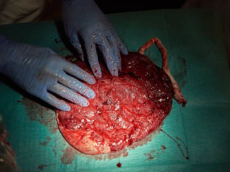 Téléchargez les photos : Un placenta sur une table peu après la naissance - en image libre de droit