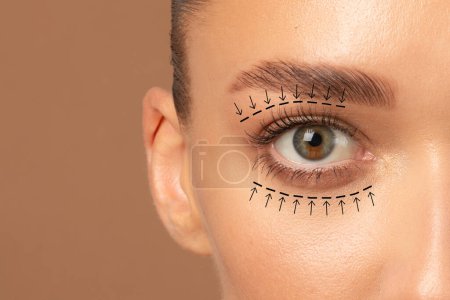 Blepharoplasty concept. Closeup view of lady eye with arrows point in direction of planned oculoplastic surgery to tighten and lift the skin around the eyes