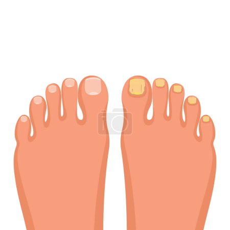Enfermedad de uñas. Concepto de onicomicosis. Infección micótica de uñas. La paroniquia es la inflamación de la piel alrededor de la uña del pie. Enfermedad fúngica, psoriasis. Ilustración vectorial diseño plano. 