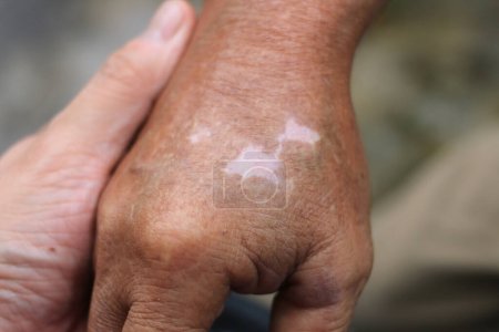 Nahaufnahme der Hände des alten Mannes mit Vitiligo-Hautverfärbung. eine Lebensweise mit saisonalen Hauterkrankungen. Vitiligo, eine Erkrankung, die Flecken auf der Haut verursacht, ist ein Symbol des Kampfes und der Anstrengung.