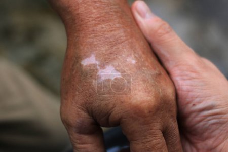 Photo for Close-up of old man's hands with vitiligo skin discoloration. a way of life with seasonal skin conditions. Vitiligo, a condition that causes patches on the skin, is a symbol of struggle and effort. - Royalty Free Image