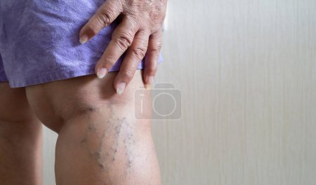 Krampfadern bei einer älteren Frau. Entzündete erweiterte Venen in den Beinen. Das Konzept der Krampfaderkrankheit und Kosmetologie.