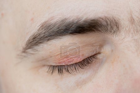 Téléchargez les photos : Peeling and swelling on the eyelid of the human eye - en image libre de droit