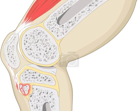 Osgood-Schlatter-Krankheitsdiagramm: Dieser anschauliche Leitfaden beschreibt anschaulich die Osgood-Schlatter-Krankheit, eine häufige Knieerkrankung bei Jugendlichen. Es hebt die anatomischen Aspekte hervor und betont die Entzündung an der Tibiatuberosität.