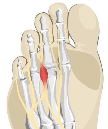 L'inflammation des nerfs du pied, ou névrite, est une affection dans laquelle les nerfs du pied deviennent irrités, causant douleur, picotements et inconfort. Les causes courantes comprennent les blessures, la compression ou les conditions sous-jacentes. 