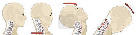 Téléchargez les photos : Le coup de fouet est une blessure au cou généralement causée par un mouvement de va-et-vient soudain, fréquent dans les accidents de voiture. Les symptômes comprennent des douleurs au cou, une raideur et des maux de tête. Une attention médicale rapide est cruciale pour le diagnostic et le traitement de la douleur. - en image libre de droit