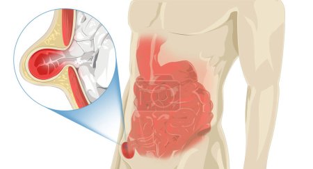 Douleur à l'estomac Hernie se produit lorsqu'un organe interne pousse à travers les muscles faibles, provoquant un inconfort. Les symptômes comprennent une douleur localisée, un gonflement et un gonflement visible. Le traitement peut impliquer des changements de mode de vie, des médicaments ou une chirurgie. 