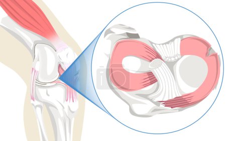 L'illustration du ménisque déchiré capture clairement les structures complexes de l'articulation du genou, mettant en valeur la déchirure du ménisque. Avec précision, il transmet l'anatomie de la blessure commune, aidant à une compréhension complète.