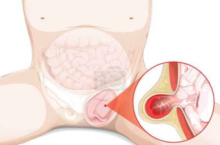 Photo for Explore the intricacies of a hernia through this vivid illustration. Clearly depicting the displacement of an organ, this visual aid simplifies a complex medical condition, aiding in understanding and awareness. - Royalty Free Image