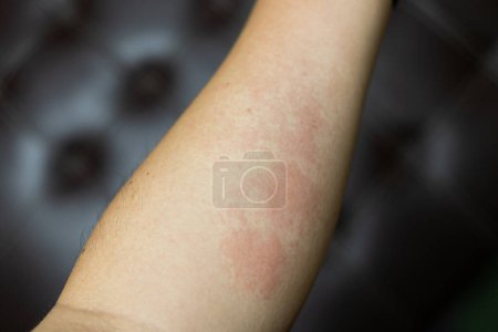 Photo for Allergic rash dermatitis eczema skin of patient. hand in scratching itchy, itch red spot or rash of skin. Healthcare. - Royalty Free Image