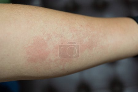 Eruption cutanée allergique dermatite eczéma peau du patient. main dans le grattage démangeaisons, démangeaisons tache rouge ou éruption cutanée. Soins de santé.