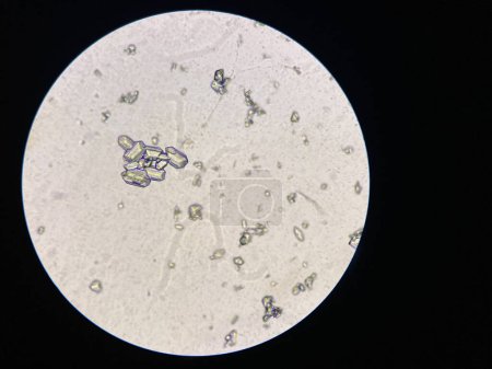 Vista microscópica de cristales de estruvita de sedimentos urinarios. Cristales de fosfato de magnesio y amonio. Causando Enfermedad del Tracto Urinario Inferior Felino 