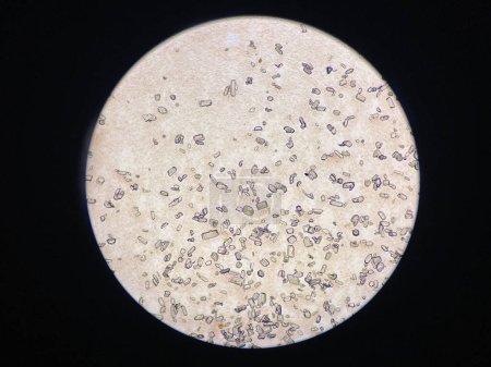 Vista microscópica de cristales de estruvita de sedimentos urinarios. Cristales de fosfato de magnesio y amonio. Causando Enfermedad del Tracto Urinario Inferior Felino 